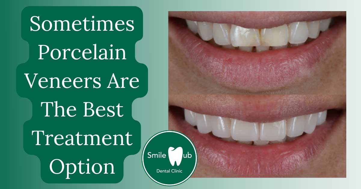 SH-12477-Porcelain-FB-#5